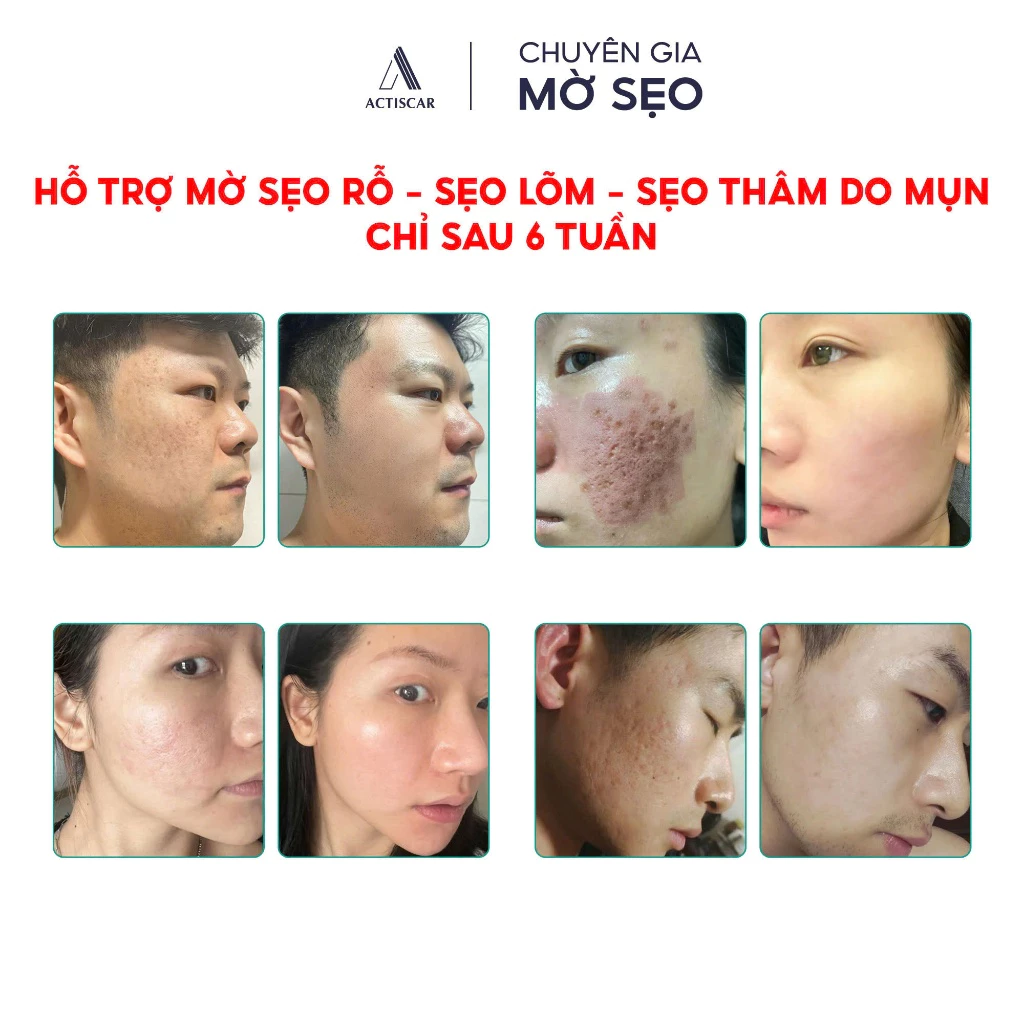 Phục hồi, làm mờ các vết sẹo lõm, rỗ chỉ sau 6 tuần