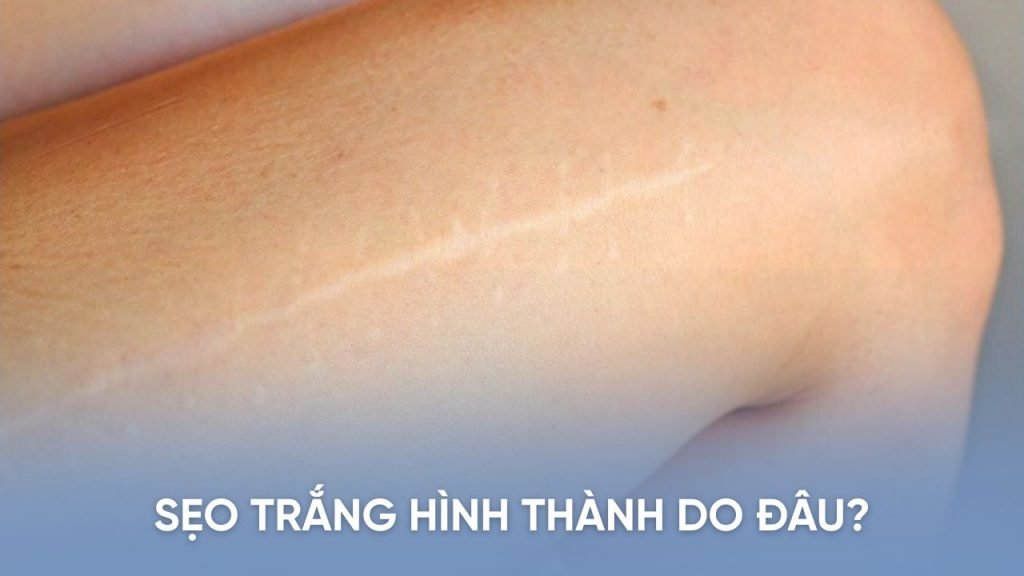 Sẹo trắng: nguyên nhân và thách thức khi điều trị