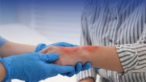 Tạm biệt sẹo xấu với kem trị sẹo bỏng an toàn