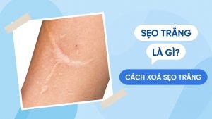 Xoá mờ sẹo với kem đặc trị sẹo trắng