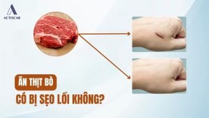 Ăn thịt bò có bị sẹo lồi hay không?