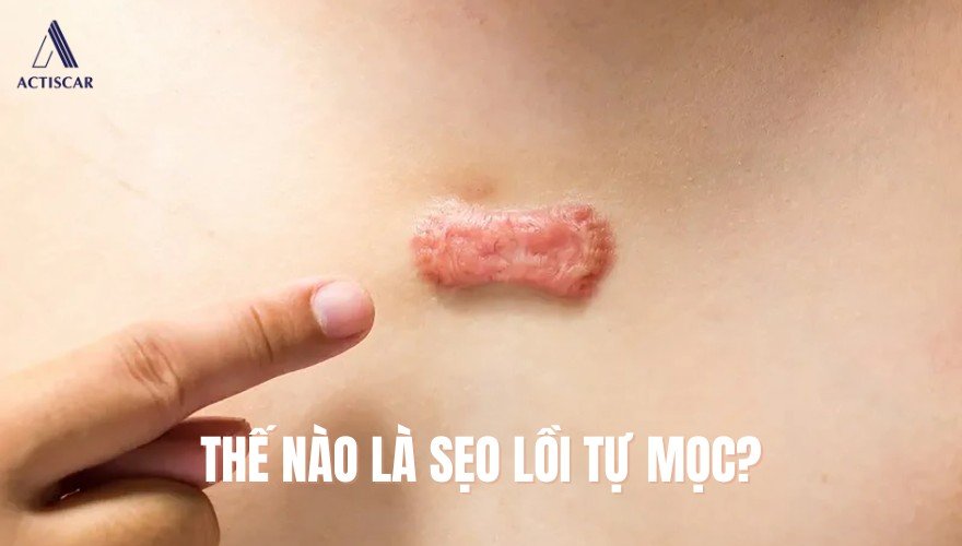 Biểu hiện của sẹo lồi tự mọc