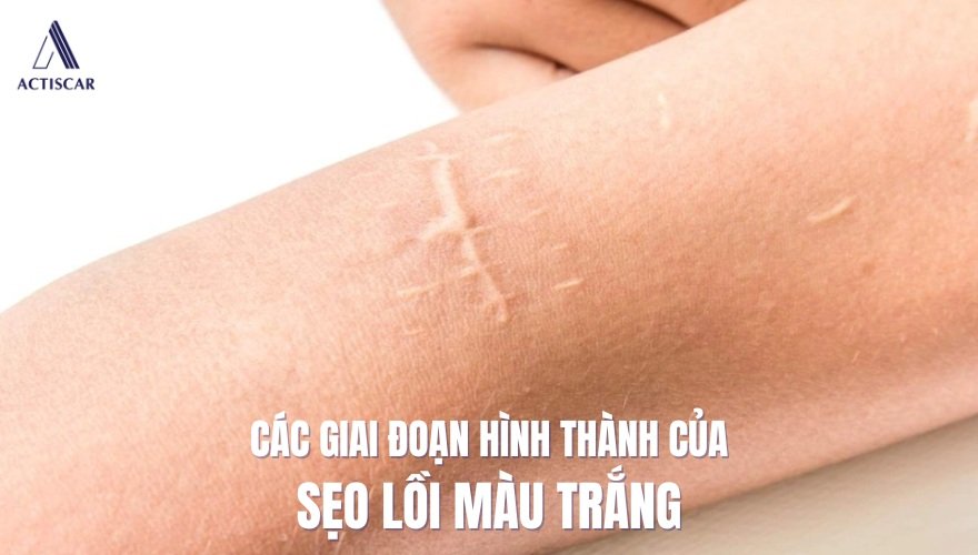 Các giai đoạn của sẹo lồi màu trắng
