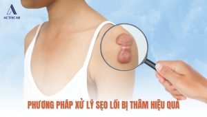 Cách xử lý sẹo lồi bị thâm an toàn