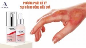 Cách xử lý sẹo lồi do bỏng tại nhà an toàn, hiệu quả