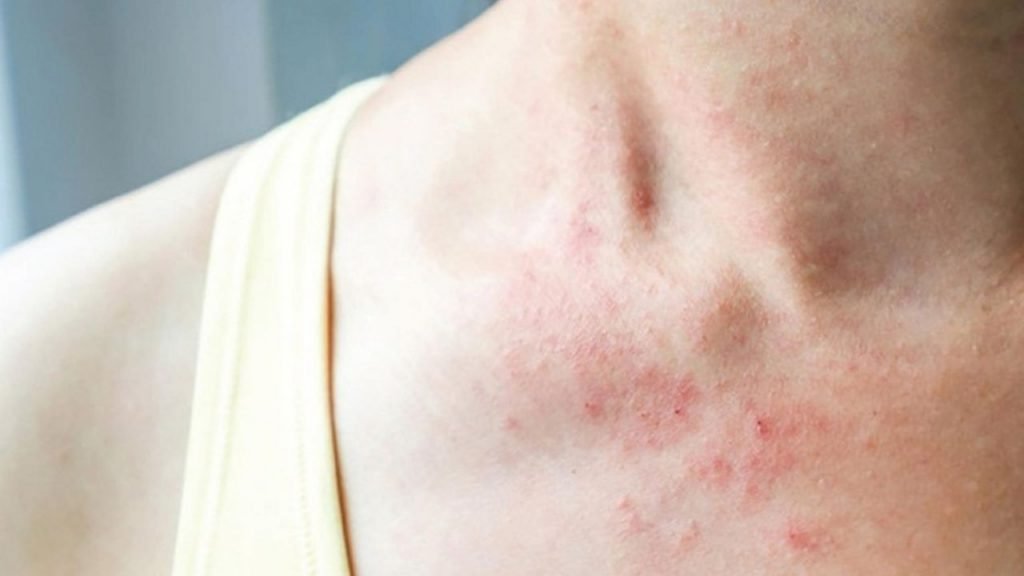 Chăm sóc da bị Zona đúng cách giúp hạn chế hình thành sẹo xấu