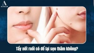 Có nên sử dụng kem trị sẹo thâm sau khi tẩy nốt ruồi