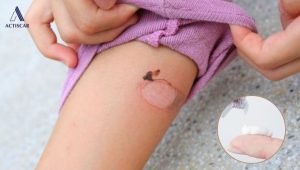 Kem trị sẹo bỏng bô, giải pháp xoá mờ sẹo an toàn tại nhà