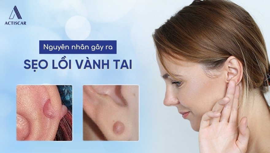 Nguyên nhân sẹo lồi vành tai dễ hình thành