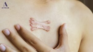 Nhận biết sẹo lồi co kéo trên cơ thể