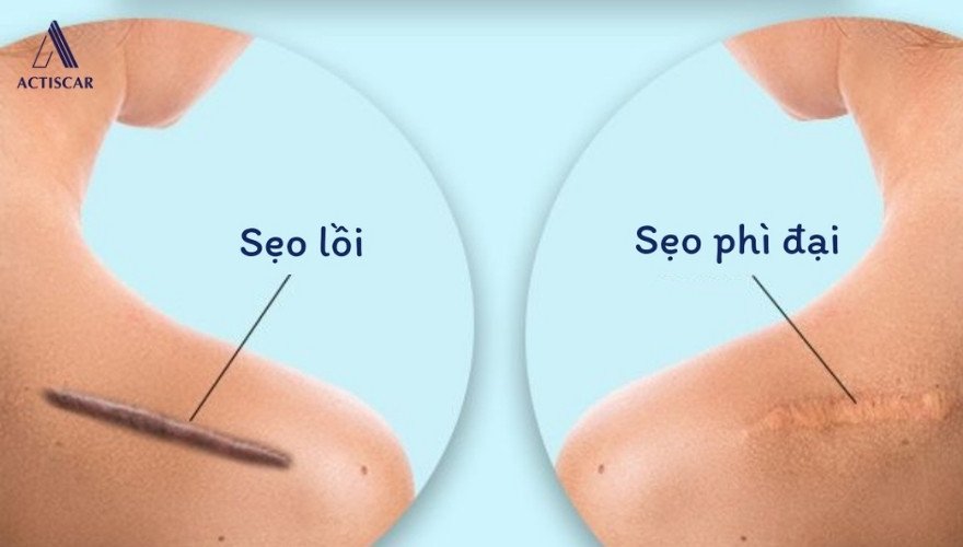 Phân biệt sẹo lồi và sẹo phì đại