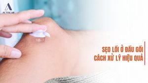 Phương pháp xoá mờ sẹo lồi đầu gối hiệu quả