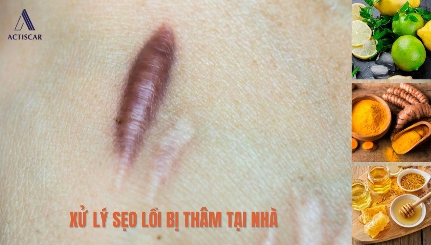 Phương pháp xử lý sẹo lồi bị thâm tại nhà
