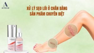 Phương pháp xử lý sẹo lồi ở chân bằng sản phẩm chuyên biệt