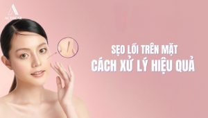Phương pháp xử lý sẹo lồi trên mặt hiệu quả