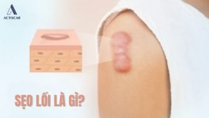 Sẹo lồi là gì? có gây hại hay không?