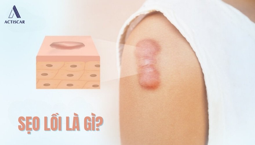 Sẹo lồi là gì? có gây hại hay không?