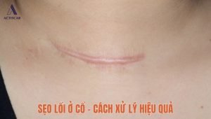 Sẹo lồi ở cổ và cách xử lý sẹo hiệu quả