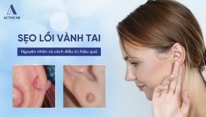 Sẹo lồi vành tai - nguyên nhân và cách điều trị