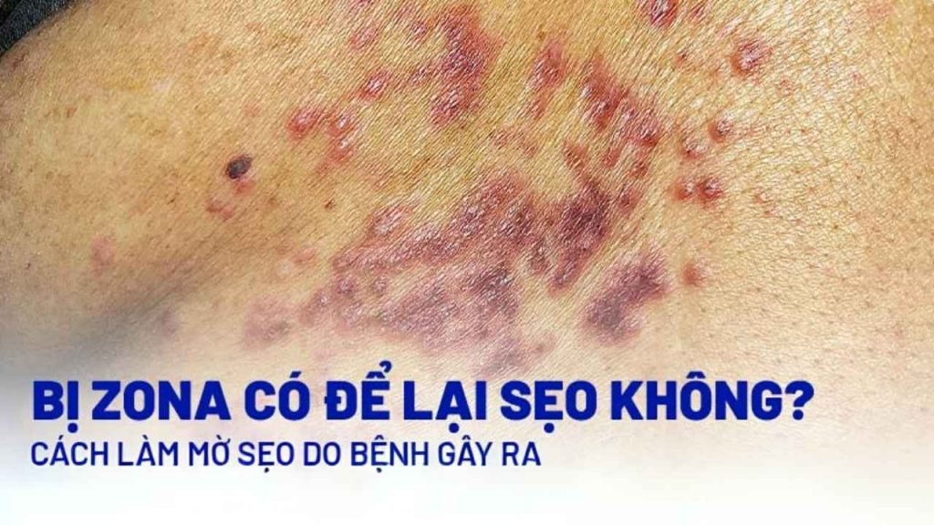 Sử dụng kem trị sẹo sau Zona để xử lý sẹo xấu