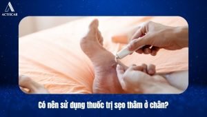 Thuốc trị sẹo thâm ở chân có nên sử dụng hay không?