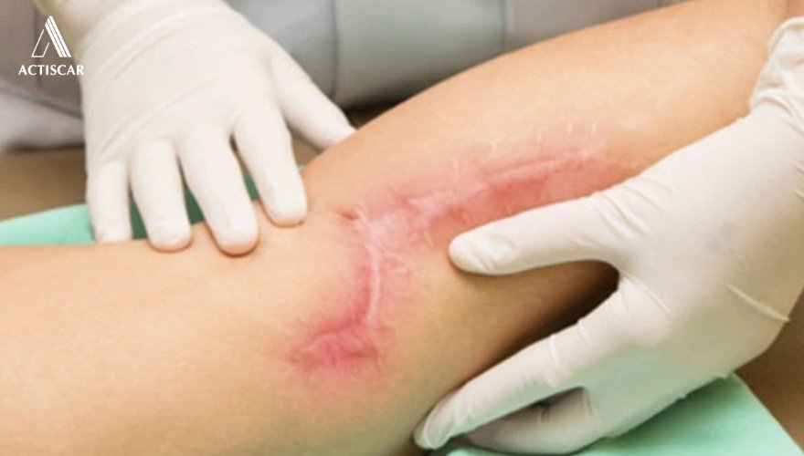 Vì sao lại dễ hình thành sẹo lồi ở chân