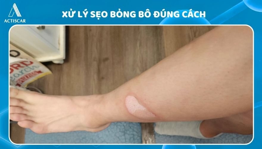 Xử lý đúng cách giúp vết bỏng bô không để lại sẹo