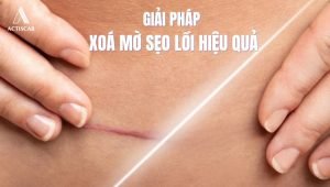 Xử lý sẹo lồi cơ địa khoa học, đảm bảo an toàn