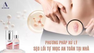 Xử lý sẹo lồi tự mọc an toàn tại nhà với bộ đôi Actiscar