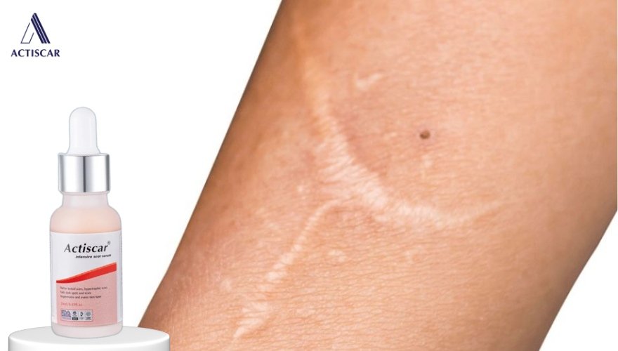 Xử lý xoá mờ sẹo lồi với Serum sẹo lồi