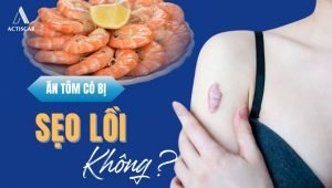 Ăn tôm có bị sẹo lồi không