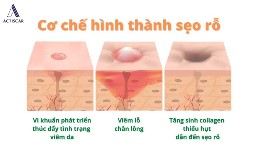 Bản chất và cơ chế hình thành sẹo rỗ