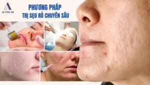 Các phương pháp điều trị sẹo rỗ chuyên sâu
