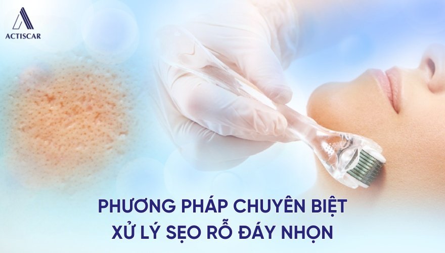 Các phương pháp điều trị sẹo rỗ chuyên sâu