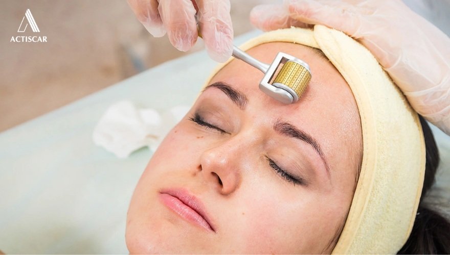 Các phương pháp xử lý sẹo lõm chuyên sâu