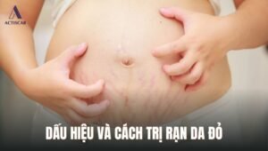 Dấu hiệu và cách xử lý rạn da đỏ