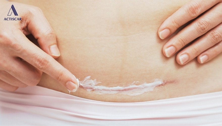 Kem mờ sẹo lồi - Phương án xử lý sẹo tại nhà hiệu quả