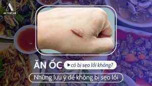 Liệu ăn ốc có bị sẹo lồi không?