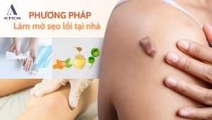 Một số phương pháp hỗ trợ xử lý sẹo lồi tại nhà