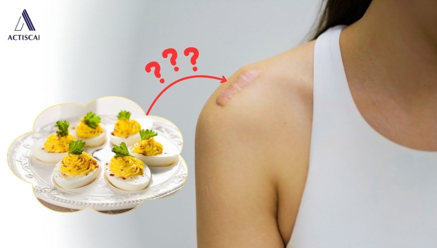 Nguyên nhân khiến mọi người nghĩ ăn trứng gây sẹo