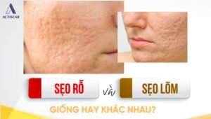 Phân biệt giữa sẹo lõm và sẹo rỗ