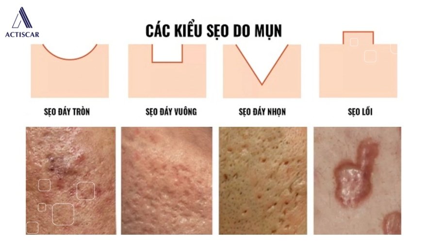 Sẹo lõm là gì, các kiểu sẹo lõm thường gặp