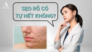 Sẹo rỗ có tự hết không?