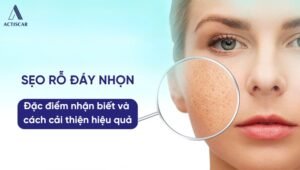 Sẹo rỗ đáy nhọn là gì? Cách cải thiện hiệu quả