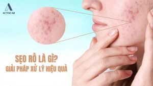 Sẹo rỗ là gì? giải pháp xử lý sẹo rỗ