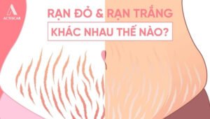 Phân biệt giữa rạn da đỏ và rạn trắng