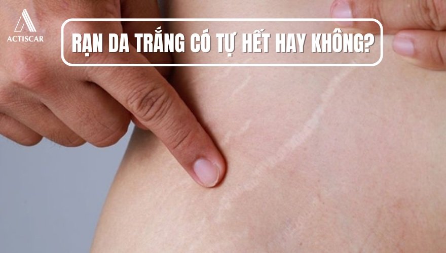 Rạn da trắng có tự hết theo thời gian hay không